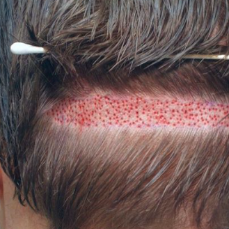 Hair Transplant In Pakistan
